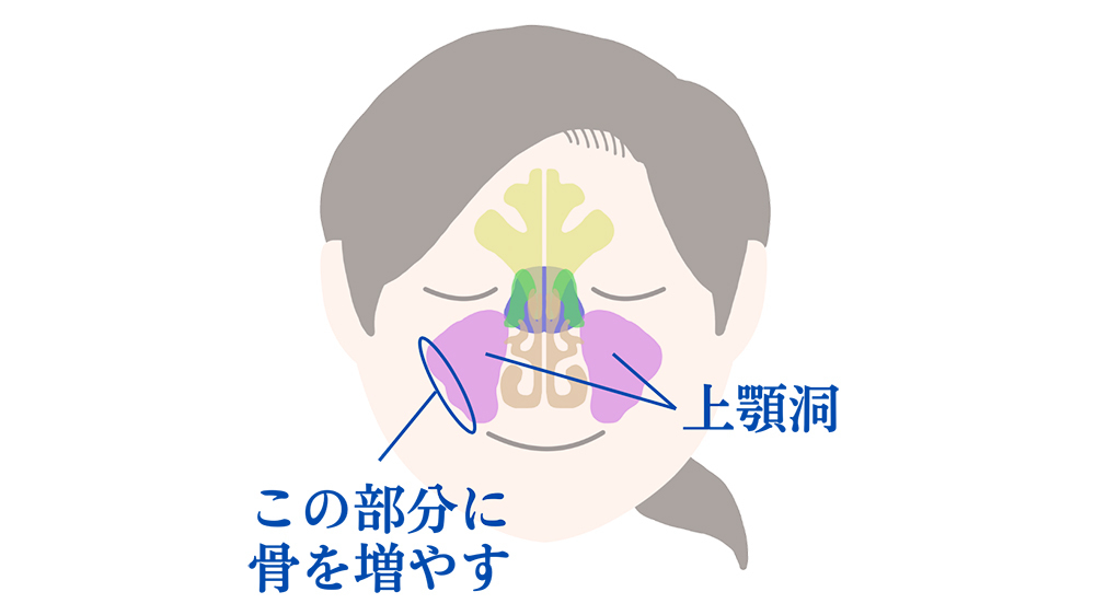 ソケットリフトによる骨造成のイメージ