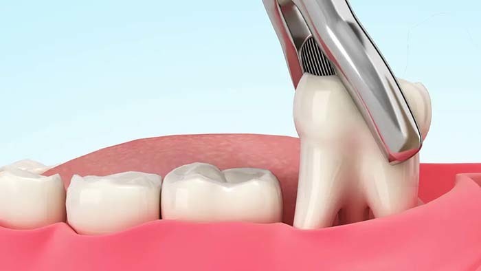 歯を抜歯している治療イメージ