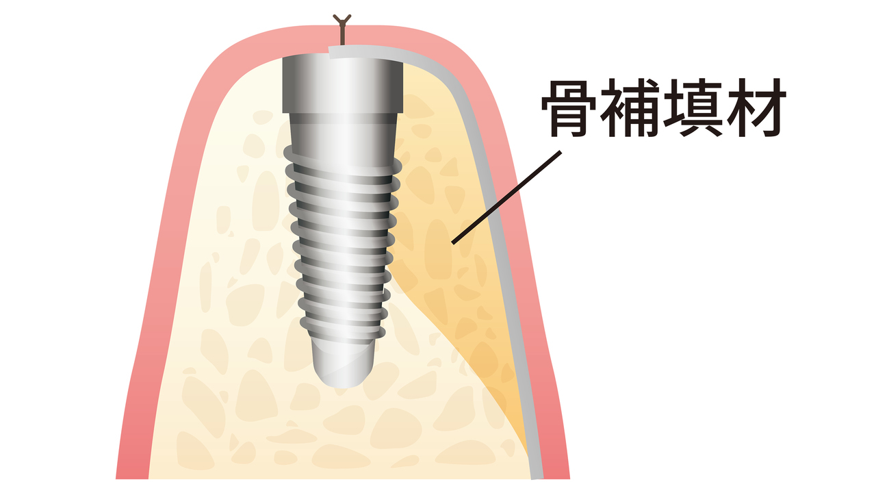 GBRで骨を再生するインプラント治療のイメージ