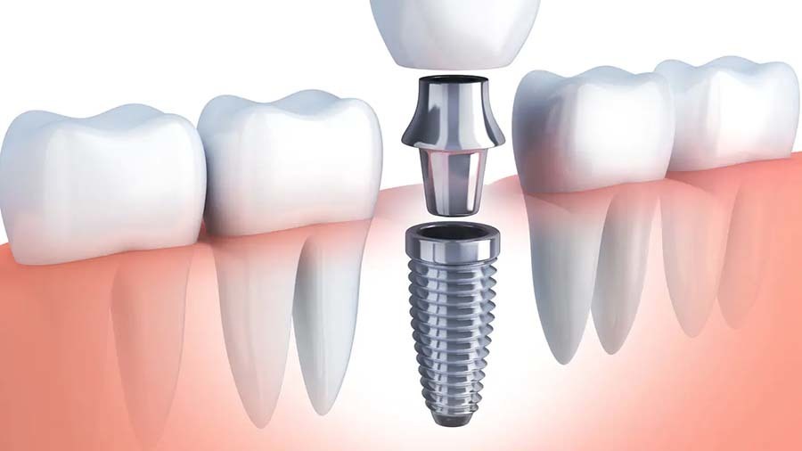 インプラント体が埋入された歯の模型